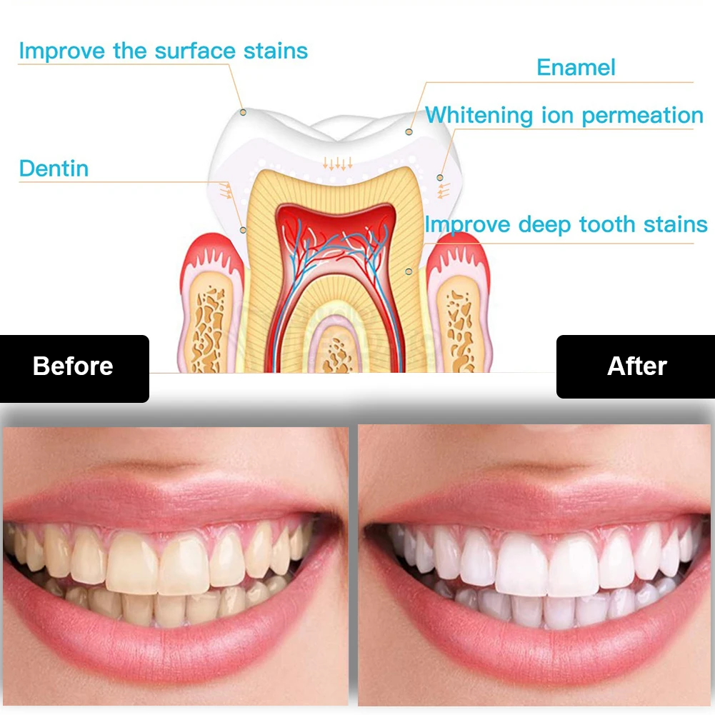 طقم تبييض الأسنان صغير 16 LED  - مراجعة Whitening Pen Bleach وسعره