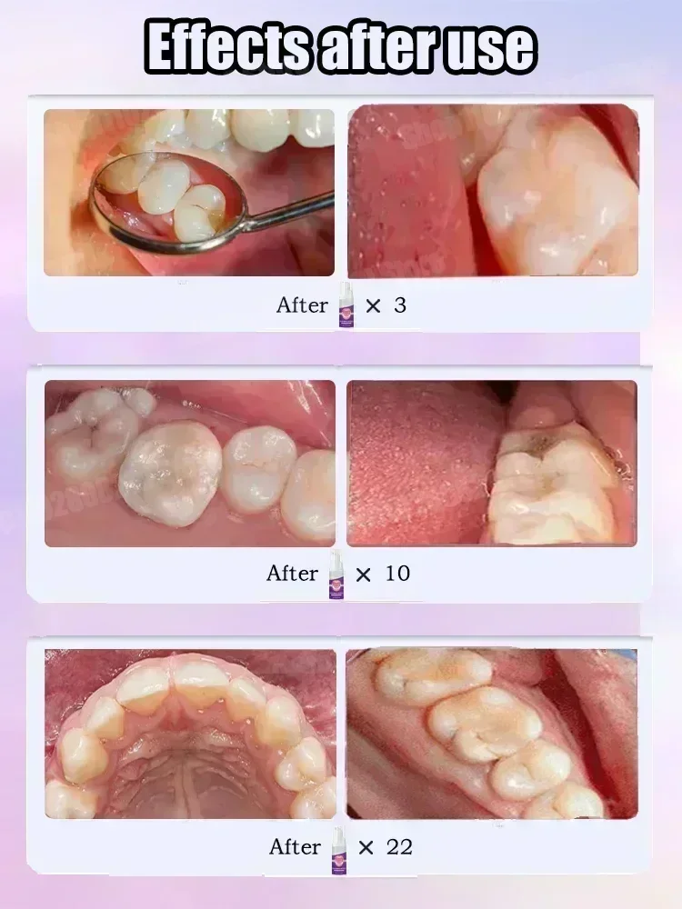 معجون أسنان لتنظيف الأسنان يزي - مراجعة Teeth Whitening Treatment وسعره
