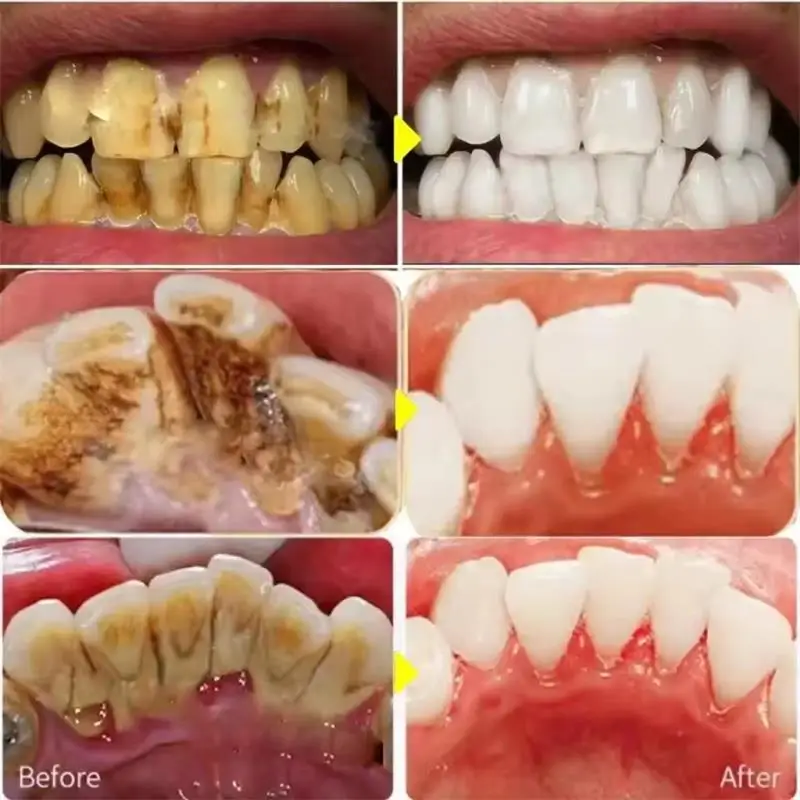 قلم معجون أسنان سريع لتبييض ال - مراجعة Whitening Pen Bleach وسعره