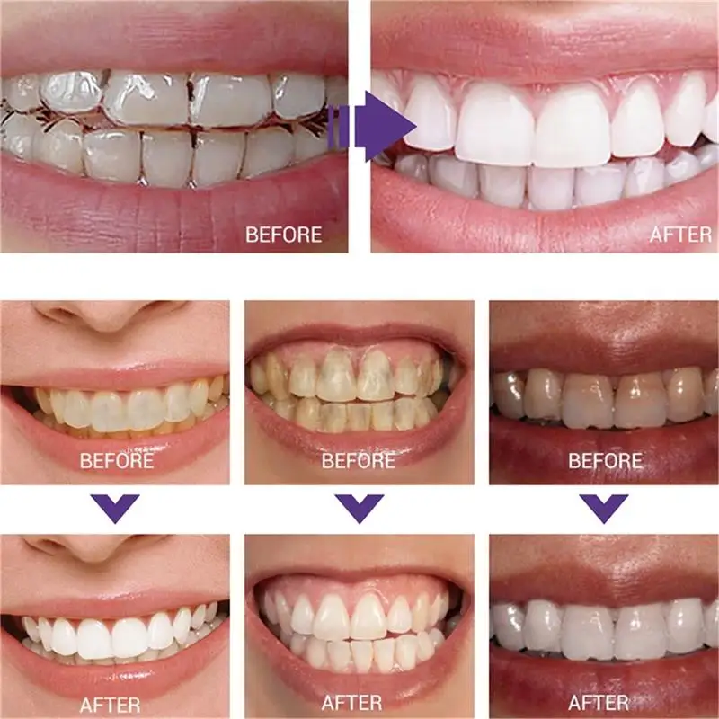 قلم معجون أسنان سريع لتبييض ال - مراجعة Whitening Pen Bleach وسعره